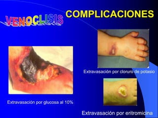 Extravasación por cloruro de potasio
Extravasación por glucosa al 10%
COMPLICACIONES
Extravasación por eritromicina
 