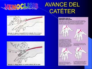AVANCE DEL
CATÉTER
 