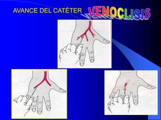 AVANCE DEL CATÉTER
 