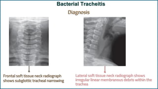 Traqueitis Rx 06 Acute Laryngitis and Bacterial Tracheitis_260210_211336.pdf