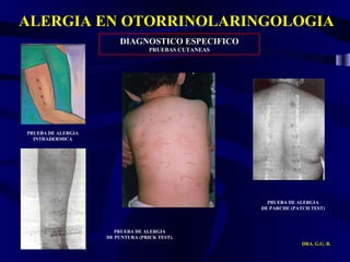 ALERGIA EN OTORRINOLARINGOLOGIA DRA. G.G. R. DIAGNOSTICO ESPECIFICO PRUEBAS CUTANEAS PRUEBA DE ALERGIA  DE PARCHE (PATCH TEST)  PRUEBA DE ALERGIA  DE PUNTURA (PRICK TEST).  PRUEBA DE ALERGIA  INTRADERMICA  