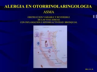 ALERGIA EN OTORRINOLARINGOLOGIA DRA. G.G. R. ASMA OBSTRUCCION VARIABLE Y REVERSIBLE DE LAS VIAS AEREAS CON INFLAMACION E HIPERREACTIVIDAD  BRONQUIAL 