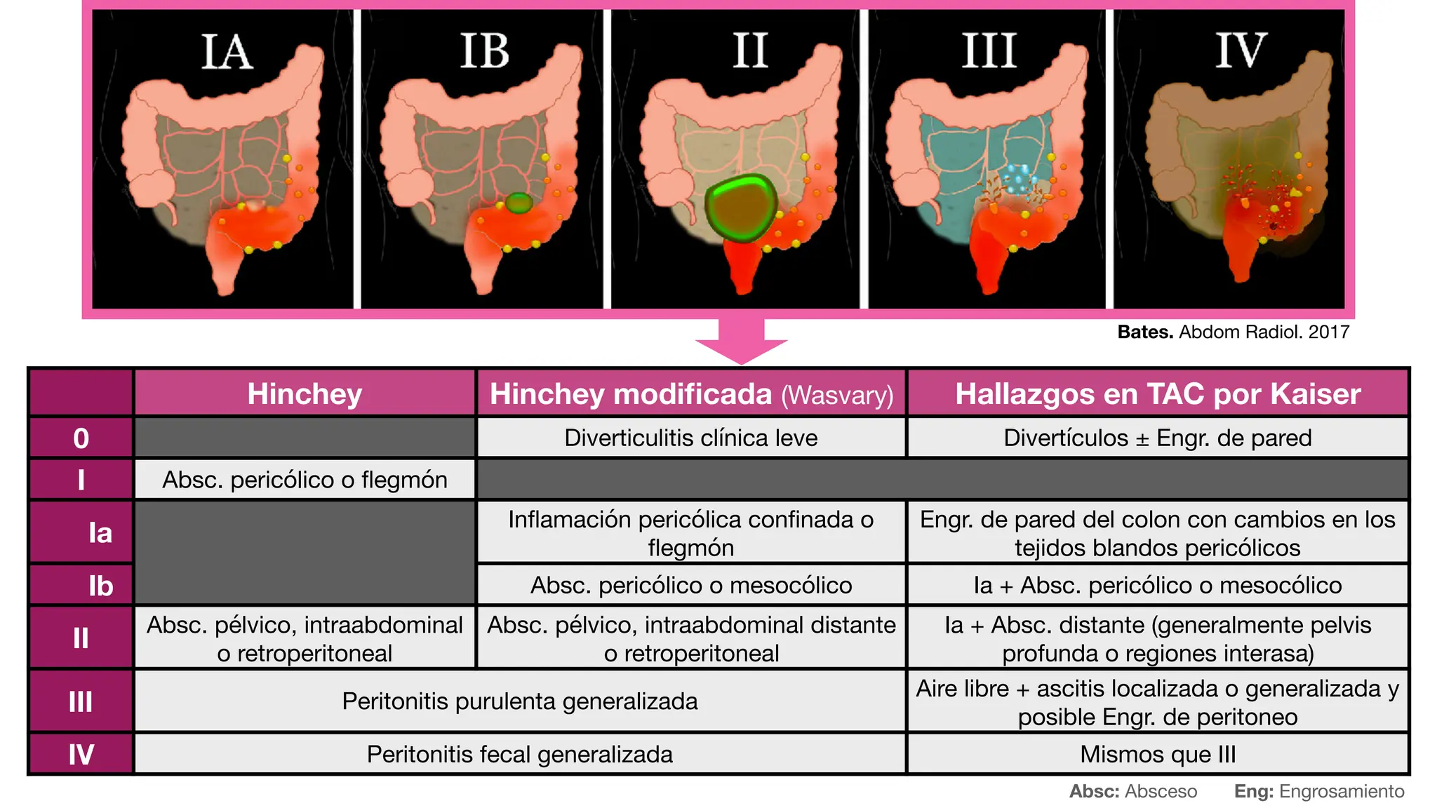 06 COMPLEMENTO Diverticulosis Y Enfermedad Diverticular Del Colon pdf 06 COMPLEMENTO Diverticulosis Y Enfermedad Diverticular Del Colon pdf