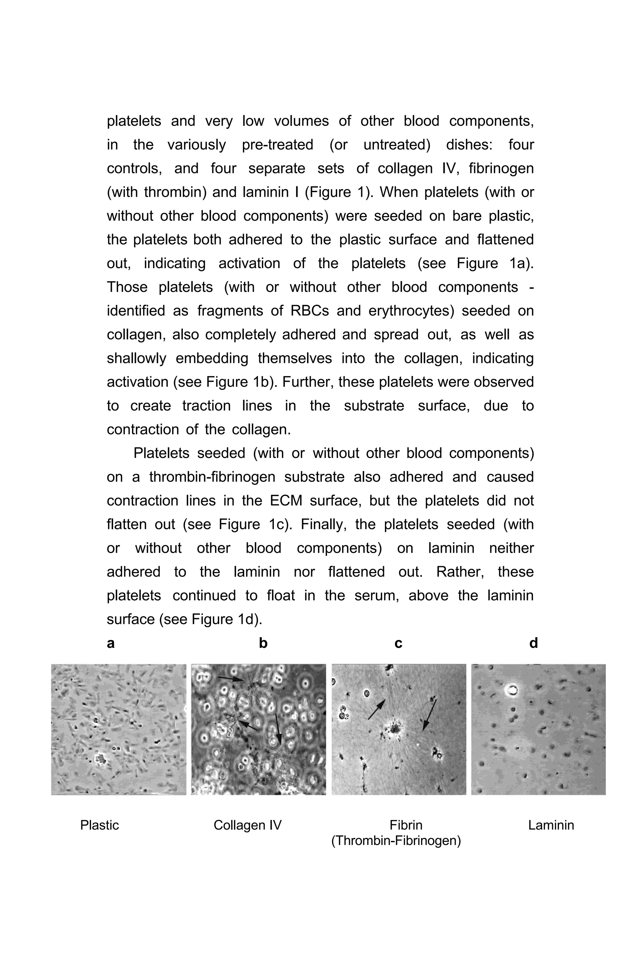 platelets and very low volumes of other blood components,
in the variously pre-treated (or untreated) dishes: four
controls, and four separate sets of collagen IV, fibrinogen
(with thrombin) and laminin I (Figure 1). When platelets (with or
without other blood components) were seeded on bare plastic,
the platelets both adhered to the plastic surface and flattened
out, indicating activation of the platelets (see Figure 1a).
Those platelets (with or without other blood components -
identified as fragments of RBCs and erythrocytes) seeded on
collagen, also completely adhered and spread out, as well as
shallowly embedding themselves into the collagen, indicating
activation (see Figure 1b). Further, these platelets were observed
to create traction lines in the substrate surface, due to
contraction of the collagen.
Platelets seeded (with or without other blood components)
on a thrombin-fibrinogen substrate also adhered and caused
contraction lines in the ECM surface, but the platelets did not
flatten out (see Figure 1c). Finally, the platelets seeded (with
or without other blood components) on laminin neither
adhered to the laminin nor flattened out. Rather, these
platelets continued to float in the serum, above the laminin
surface (see Figure 1d).
a b c d
Plastic Collagen IV Fibrin Laminin
(Thrombin-Fibrinogen)
 