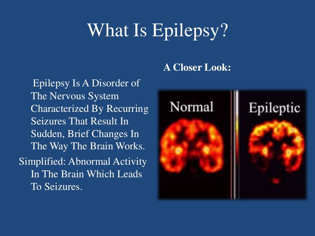 epilepsy case presentation slideshare