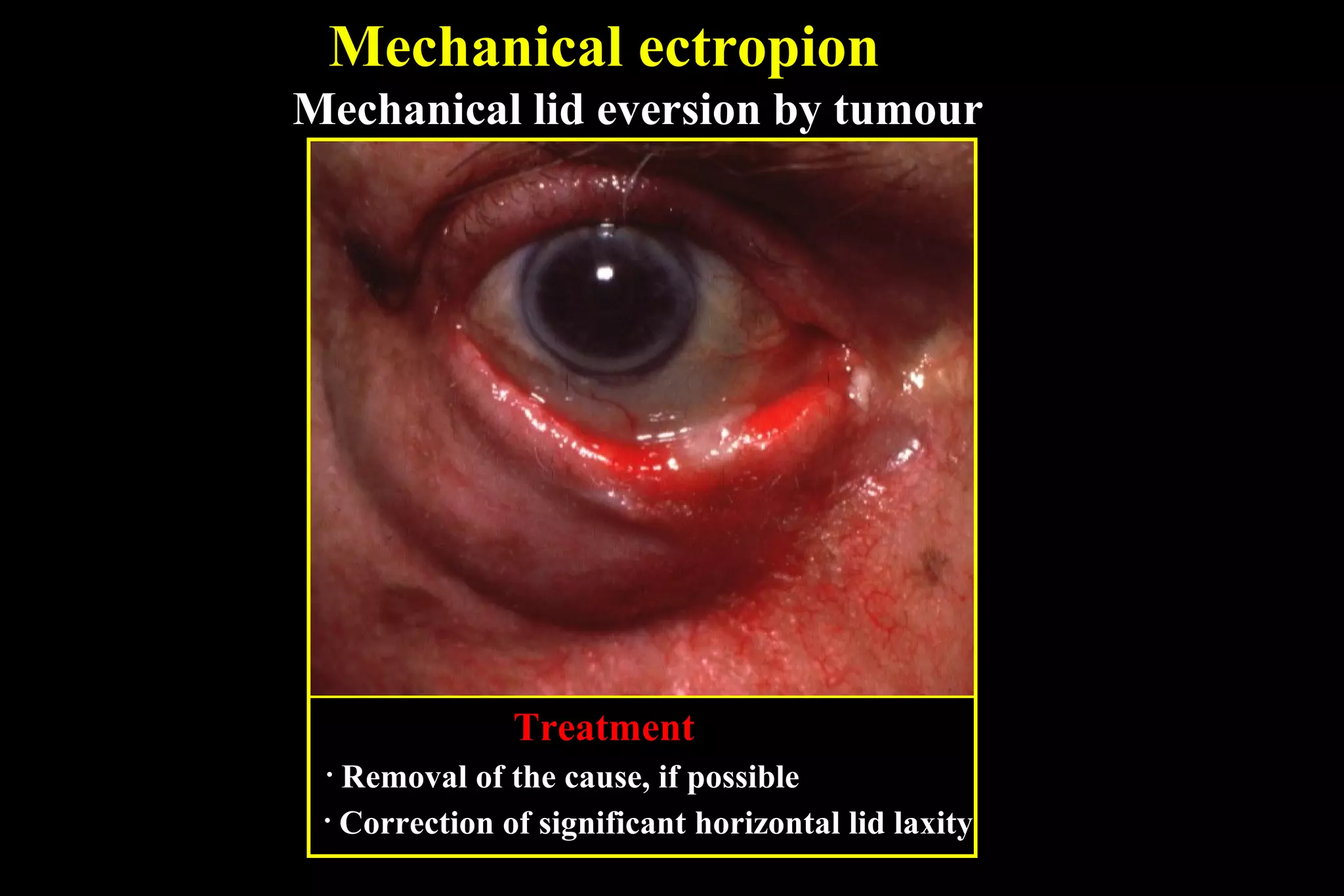 Mechanical ectropion
Mechanical lid eversion by tumour




               Treatment
 • Removal of the cause, if possible
 • Correction of significant horizontal lid laxity
 