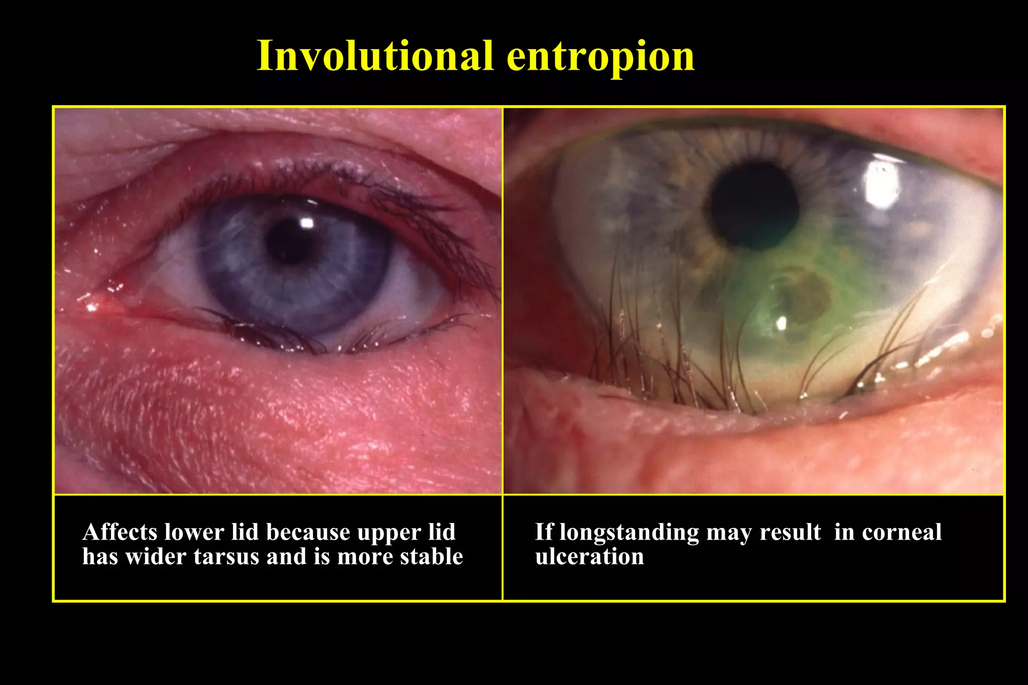 Involutional entropion




Affects lower lid because upper lid   If longstanding may result in corneal
has wider tarsus and is more stable   ulceration
 