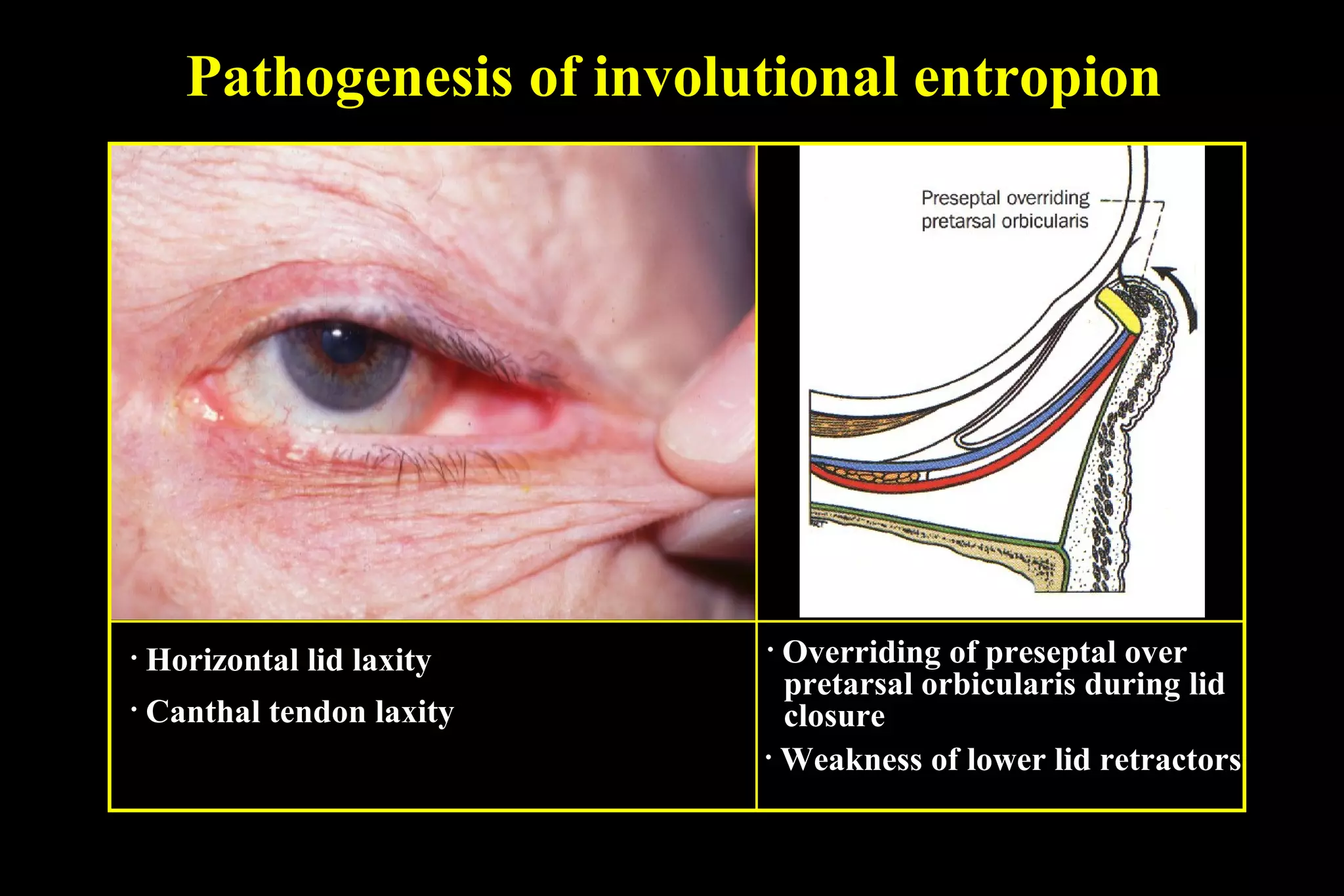 Pathogenesis of involutional entropion




•   Horizontal lid laxity   • Overriding of preseptal over
                              pretarsal orbicularis during lid
•   Canthal tendon laxity     closure
                            • Weakness of lower lid retractors
 
