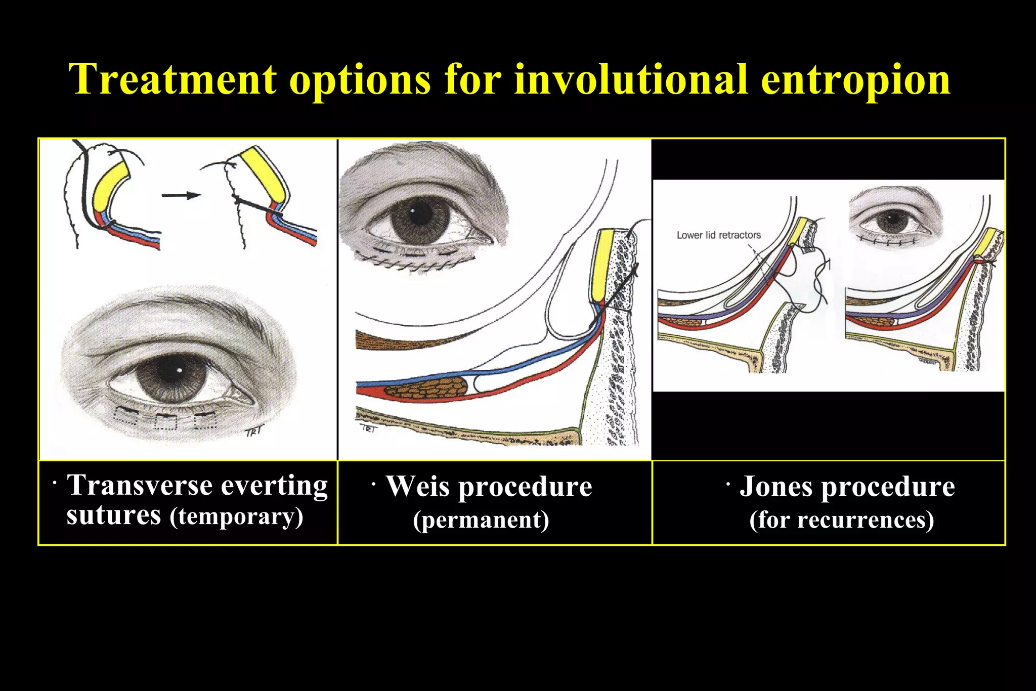 Treatment options for involutional entropion




· Transverse everting   · Weis procedure   · Jones procedure
  sutures (temporary)      (permanent)      (for recurrences)
 