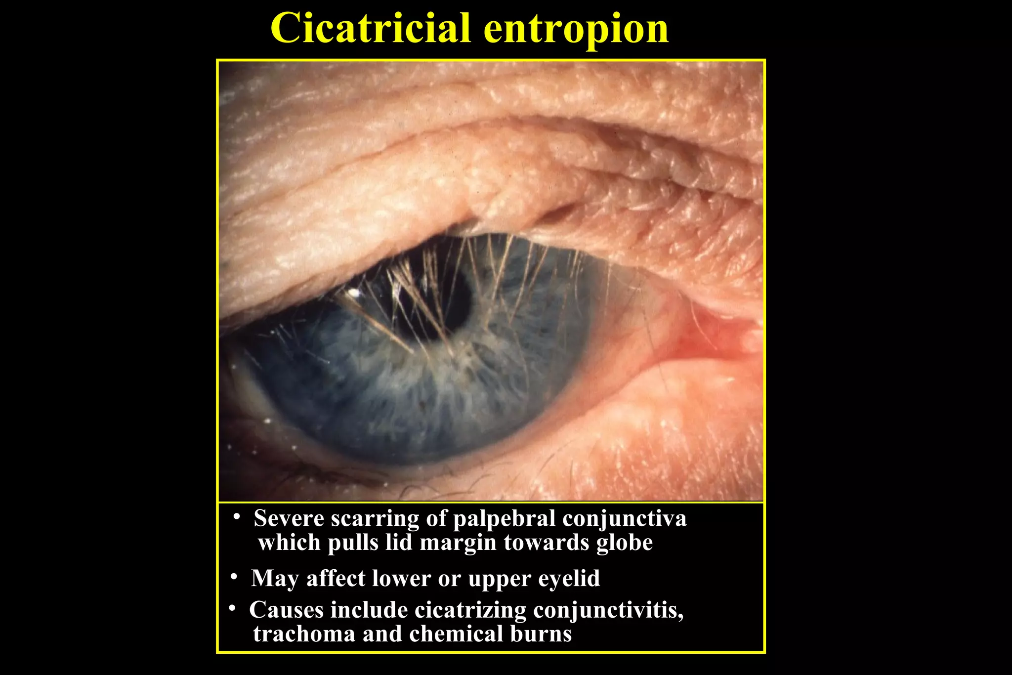 Cicatricial entropion




 • Severe scarring of palpebral conjunctiva
    which pulls lid margin towards globe
• May affect lower or upper eyelid
• Causes include cicatrizing conjunctivitis,
   trachoma and chemical burns
 