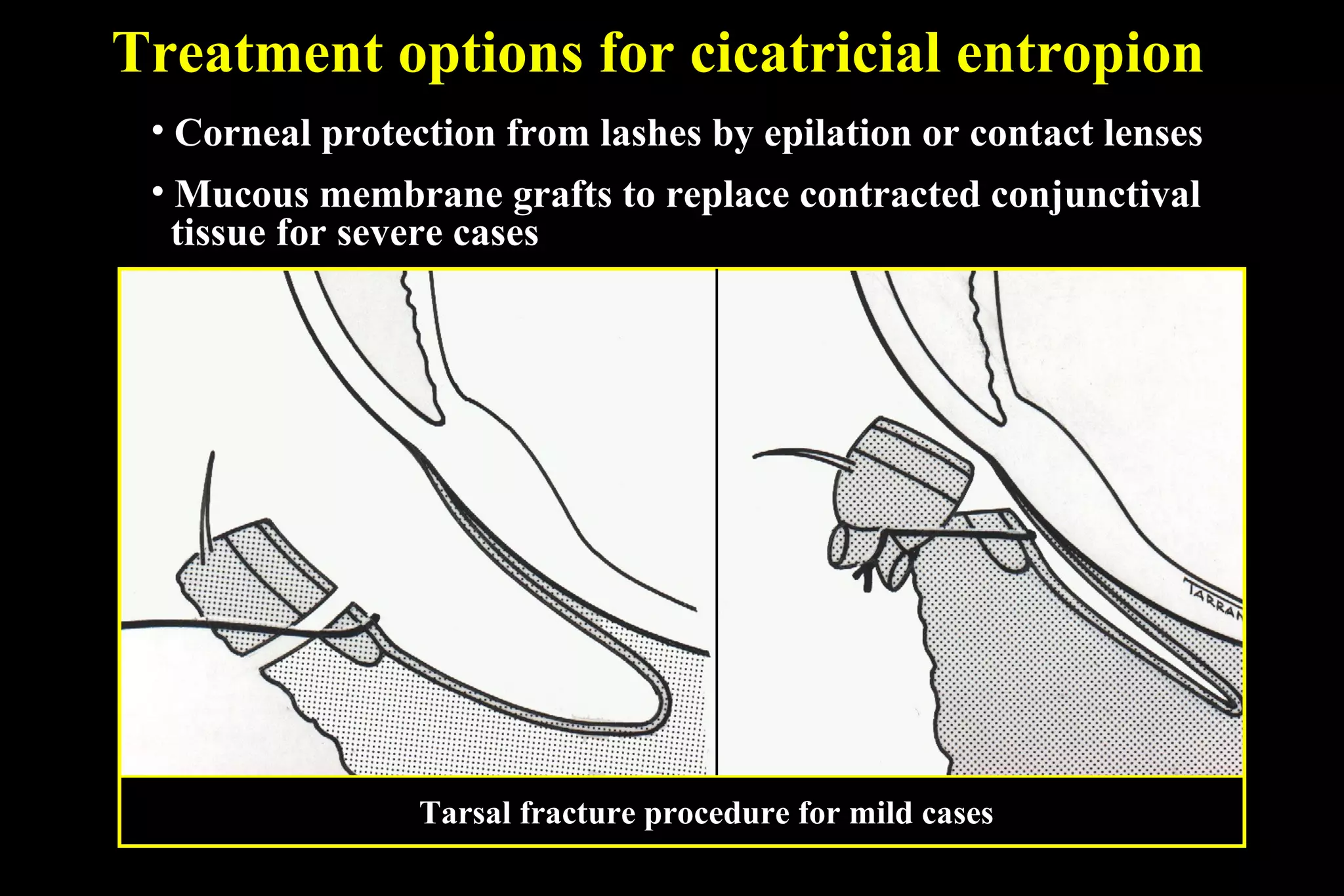 Treatment options for cicatricial entropion
 • Corneal protection from lashes by epilation or contact lenses
 • Mucous membrane grafts to replace contracted conjunctival
   tissue for severe cases




                 Tarsal fracture procedure for mild cases
 