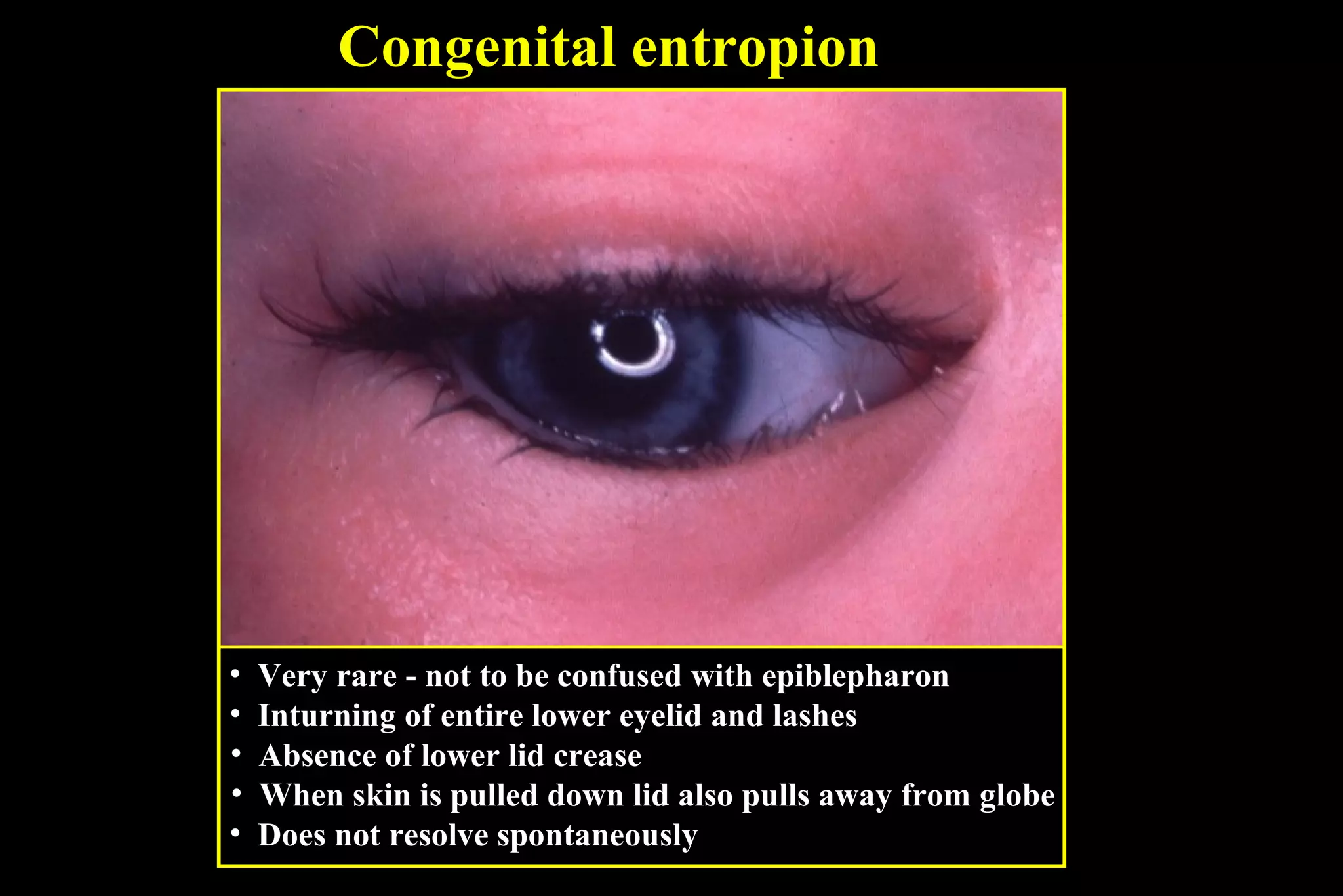 Congenital entropion




•   Very rare - not to be confused with epiblepharon
•   Inturning of entire lower eyelid and lashes
•   Absence of lower lid crease
•   When skin is pulled down lid also pulls away from globe
•   Does not resolve spontaneously
 