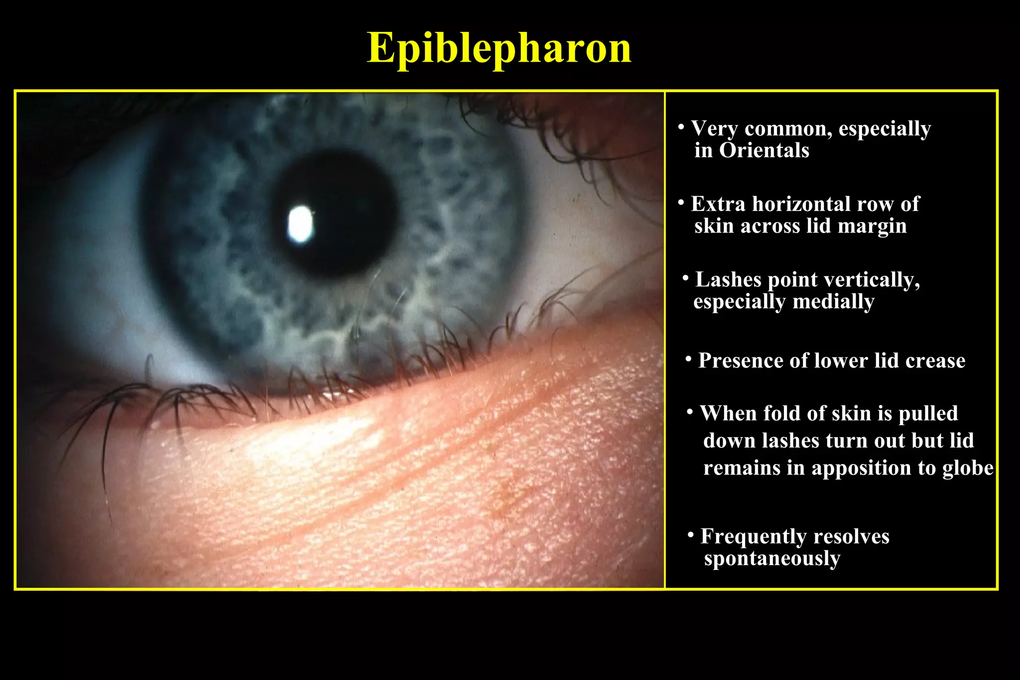 Epiblepharon
               • Very common, especially
                 in Orientals

               • Extra horizontal row of
                 skin across lid margin

               • Lashes point vertically,
                 especially medially

               • Presence of lower lid crease

               • When fold of skin is pulled
                 down lashes turn out but lid
                 remains in apposition to globe

                • Frequently resolves
                  spontaneously
 