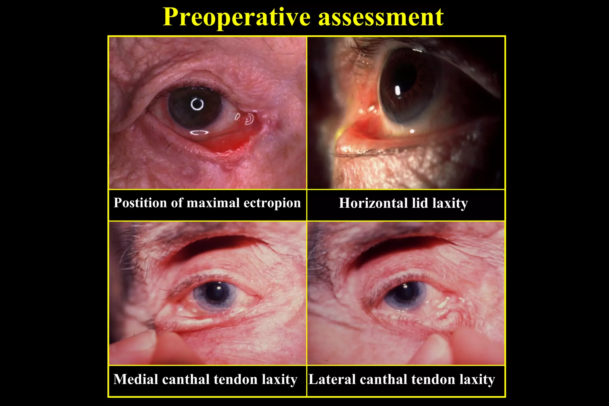 Preoperative assessment




Postition of maximal ectropion    Horizontal lid laxity




Medial canthal tendon laxity Lateral canthal tendon laxity
 