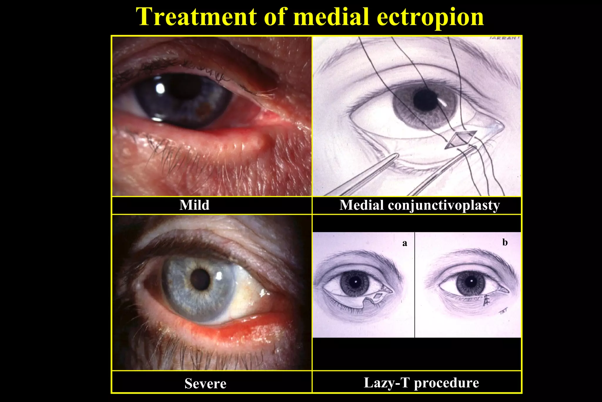 Treatment of medial ectropion




   Mild         Medial conjunctivoplasty

                         a                 b




    Severe         Lazy-T procedure
 