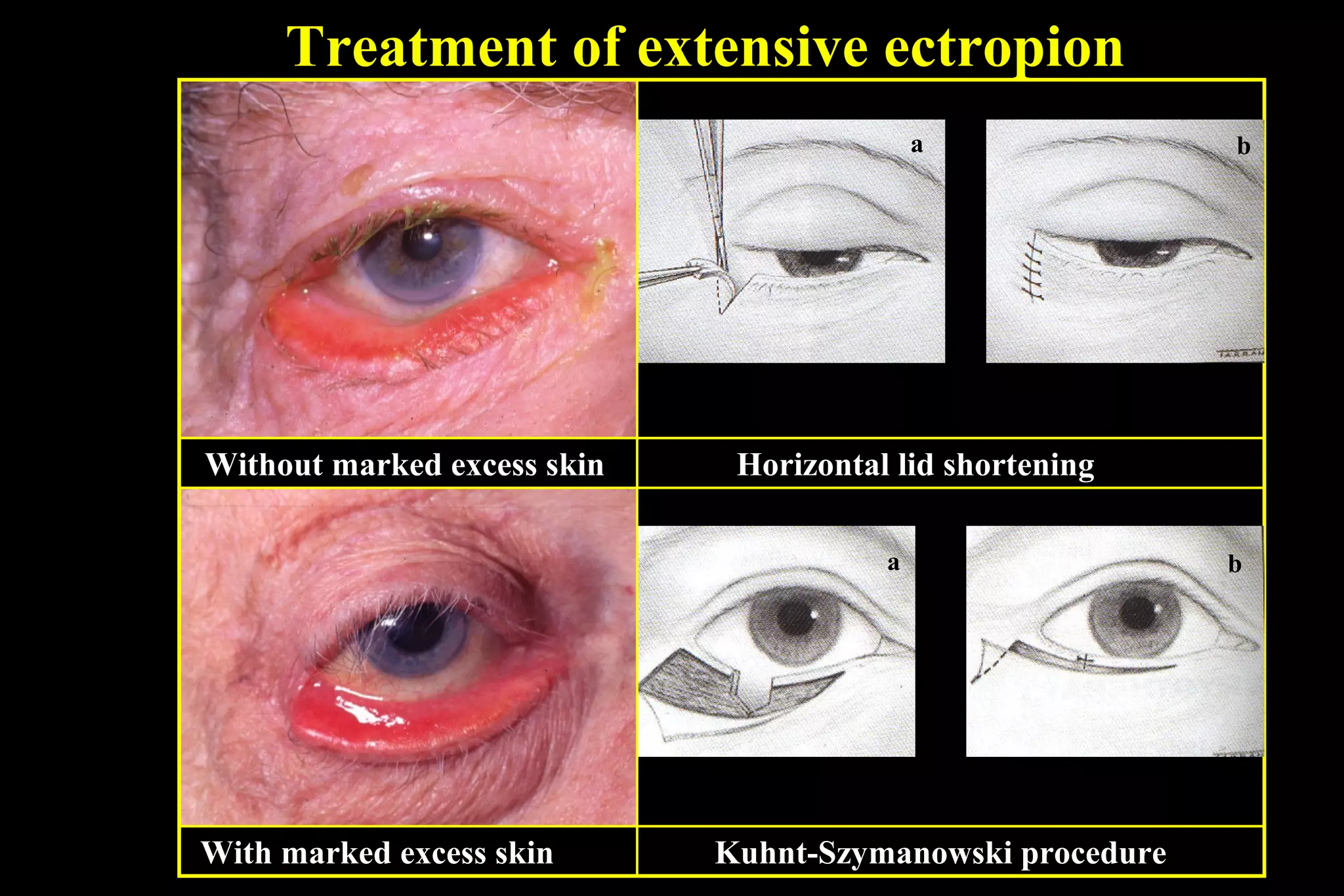 Treatment of extensive ectropion
                                            a              b




Without marked excess skin    Horizontal lid shortening

                                        a                  b




With marked excess skin      Kuhnt-Szymanowski procedure
 