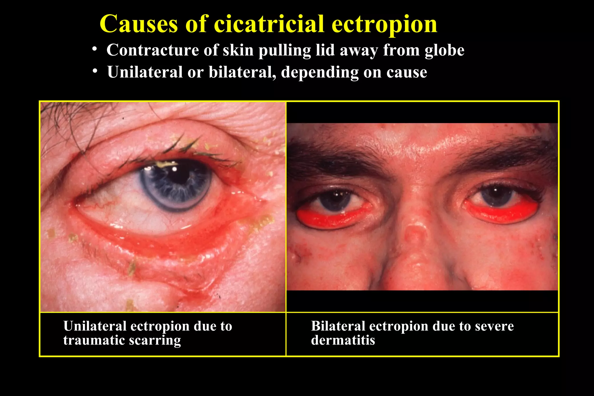 Causes of cicatricial ectropion
    • Contracture of skin pulling lid away from globe
    • Unilateral or bilateral, depending on cause




Unilateral ectropion due to     Bilateral ectropion due to severe
traumatic scarring              dermatitis
 