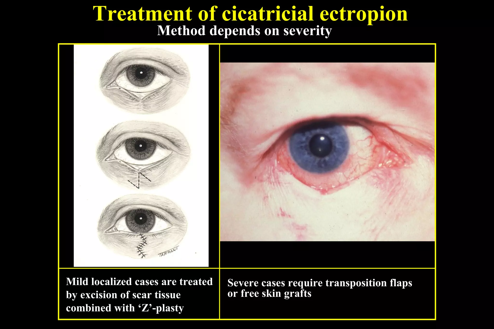 Treatment of cicatricial ectropion
                   Method depends on severity




Mild localized cases are treated   Severe cases require transposition flaps
by excision of scar tissue         or free skin grafts
combined with ‘Z’-plasty
 
