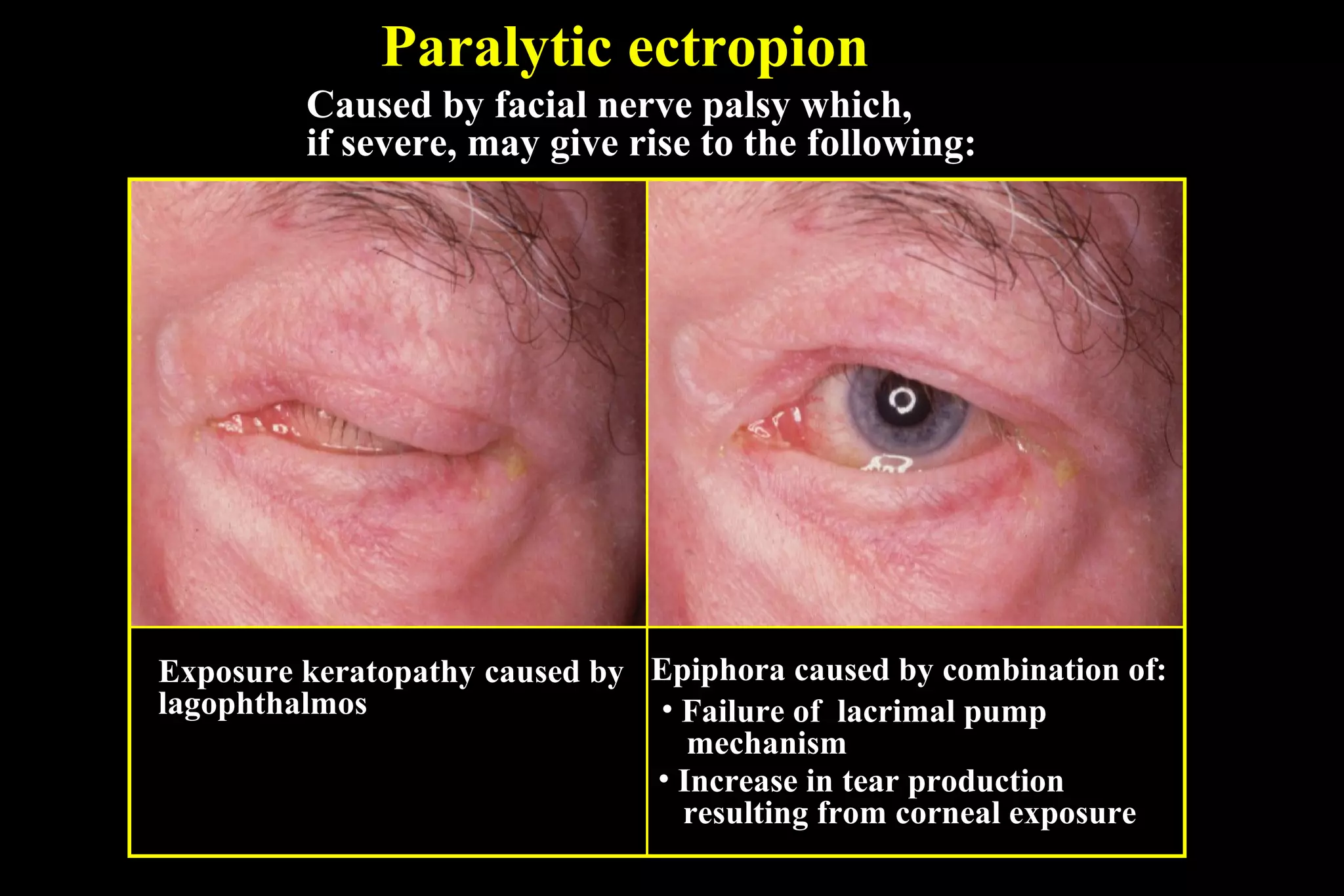 Paralytic ectropion
         Caused by facial nerve palsy which,
         if severe, may give rise to the following:




Exposure keratopathy caused by Epiphora caused by combination of:
lagophthalmos                  • Failure of lacrimal pump
                                  mechanism
                               • Increase in tear production
                                 resulting from corneal exposure
 