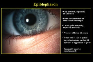 ectropion & entropion | PPT