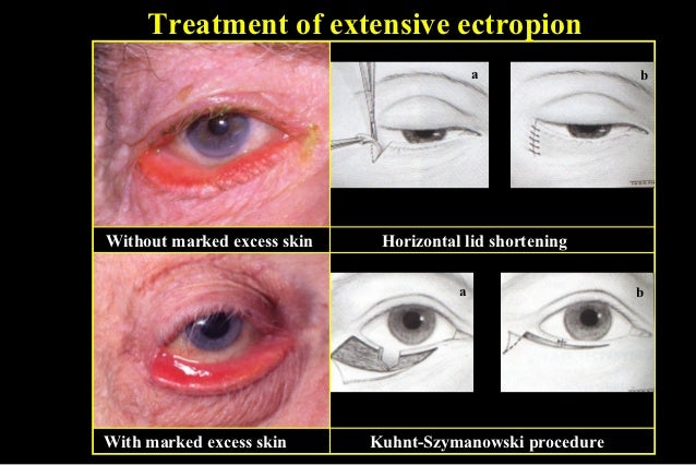 ectropion & entropion
