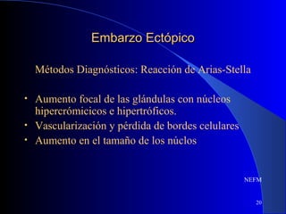 20
Embarzo EctópicoEmbarzo Ectópico
Métodos Diagnósticos: Reacción de Arias-Stella
• Aumento focal de las glándulas con núcleos
hipercrómicicos e hipertróficos.
• Vascularización y pérdida de bordes celulares
• Aumento en el tamaño de los núclos
NEFM
 