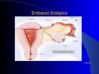 7
Embarzo EctópicoEmbarzo Ectópico
NEFM
 