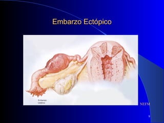 9
Embarzo EctópicoEmbarzo Ectópico
NEFM
 