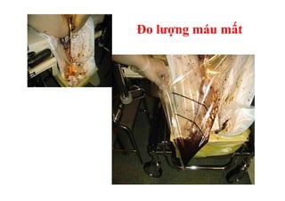 Đo lượng máu mất 
 