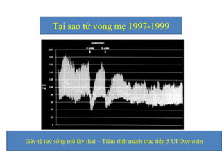 Tại sao tử vong mẹ 1997-1999 
Gây tê tuỷ sống mổ lấy thai – Tiêm tĩnh mạch trực tiếp 5 UI Oxytocin 
 