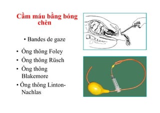 Cầm máu bằng bóng 
chèn 
• Bandes de gaze 
• 
• 
• 
Ống thông Foley 
Ống thông Rüsch 
Ống thông 
Blakemore 
• Ống thông Linton- 
Nachlas 
 