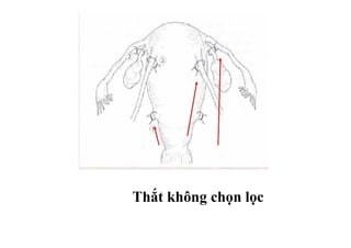 Thắt không chọn lọc 
 