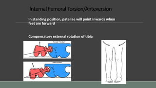 Internal Femoral Torsion/Anteversion
In standing position, patellae will point inwards when
feet are forward
Compensatory external rotation of tibia
 