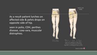 As a result patient lurches on
affected side & pelvis drops on
opposite side of hip.
seen in polio, CDH, perthes
disease, coxa vara, muscular
distrophies.
 