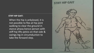 STIFF HIP GAIT:
When the hip is ankylosed, it is
not possible to flex at hip joint
walking to clear the ground in
stance phase,hence person with
stiff hip lifts pelvis on that side &
swings leg in circumduction to
take the forward step.
 