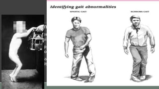 SCISSORING/SPASTIC GAIT:
This gait is characteristic of gait of a spastic child with marked b/l adductor
spasm at hip & equinus in the ankle.
The child needs support to walk & leg goes into marked adduction in swing
phase so that the foot with equinus goes across to opposite side.
Such repeated crossing of leg whle walking gives scissoring appearance
called as scissor gait.
 