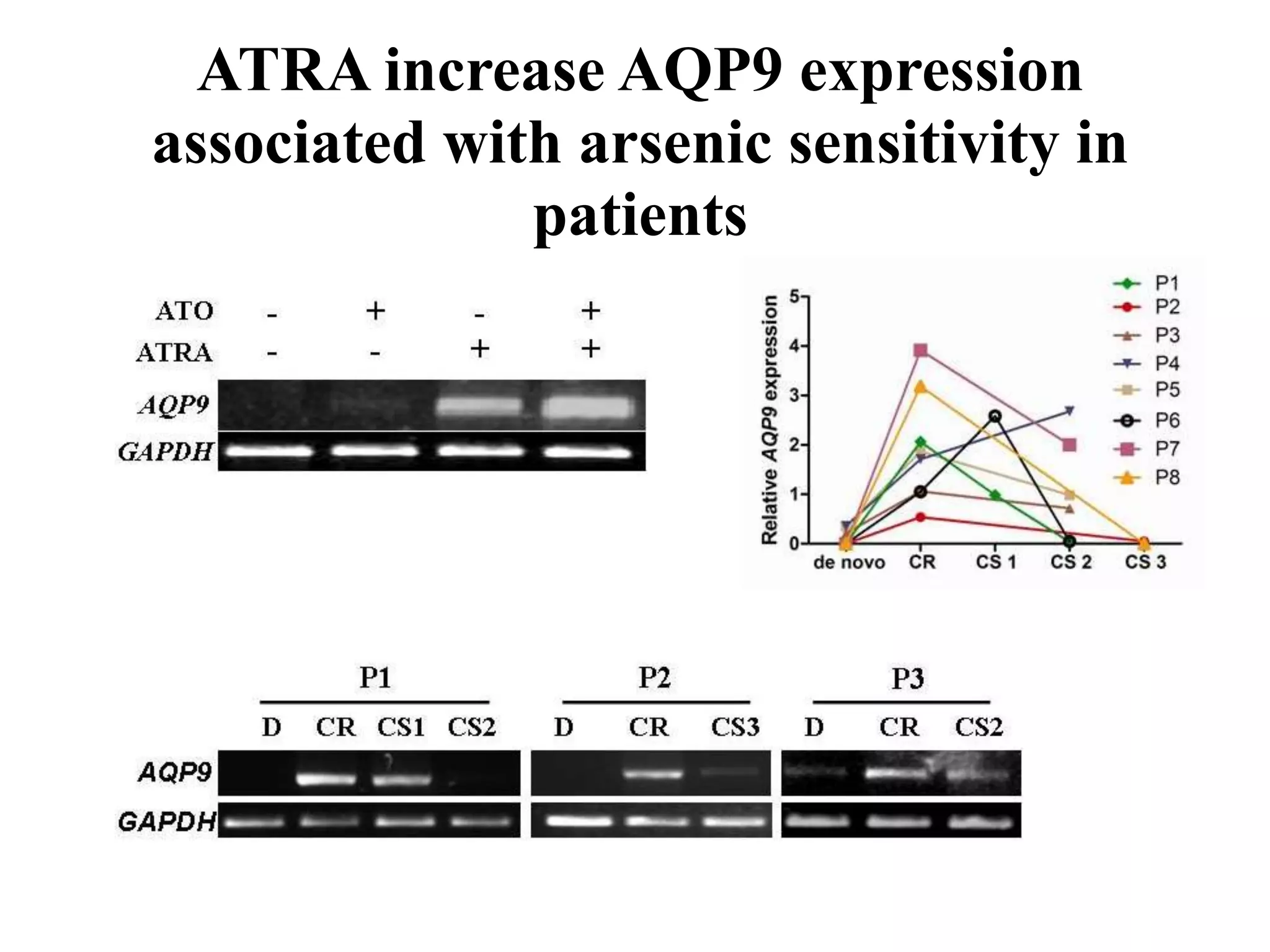 ATRA increase AQP9 expression 
associated with arsenic sensitivity in 
patients 
 