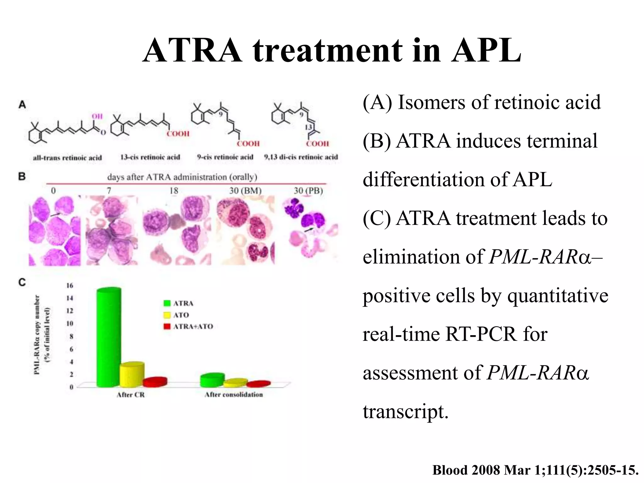 ATRA treatment in APL 
(A) Isomers of retinoic acid 
(B) ATRA induces terminal 
differentiation of APL 
(C) ATRA treatment leads to 
elimination of PML-RAR– 
positive cells by quantitative 
real-time RT-PCR for 
assessment of PML-RAR 
transcript. 
Blood 2008 Mar 1;111(5):2505-15. 
 