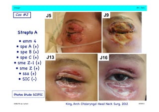 S.Dauger!JPU - Paris! 
J5 J9 
J13 J16 
Cas #2 ! 
Strepto A! 
• emm 4 ! 
• spe A (+)! 
• spe B (+)! 
• spe C (+)! 
• sme Z-1 (+)! 
• sme Z (+)! 
• ssa (+)! 
• SIC (-)! 
Photos étude SCIPIC! 
DHBN/FN de l’enfant!King, Arch Otolaryngol Head Neck Surg, 2012!19/09/13! 
 
