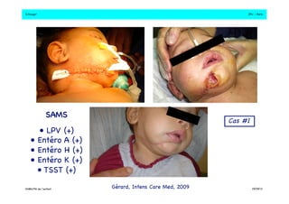 S.Dauger!JPU - Paris! 
Gérard, Intens Care Med, 2009! 
SAMS! 
• LPV (+)! 
• Entéro A (+)! 
• Entéro H (+) ! 
• Entéro K (+)! 
• TSST (+)! 
Cas #1 ! 
DHBN/FN de l’enfant!19/09/13! 
 