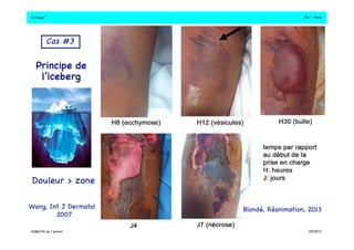 S.Dauger!JPU - Paris! 
Blondé, Réanimation, 2013! 
Cas #3 ! 
Principe de ! 
l’iceberg! 
Douleur > zone! 
Wang, Int J Dermatol! 
2007! 
DHBN/FN de l’enfant!19/09/13! 
 