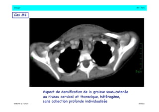 S.Dauger!JPU - Paris! 
Aspect de densification de la graisse sous-cutanée ! 
au niveau cervical et thoracique, hétérogène, ! 
sans collection profonde individualisée! 
Cas #4 ! 
DHBN/FN de l’enfant!19/09/13! 
 