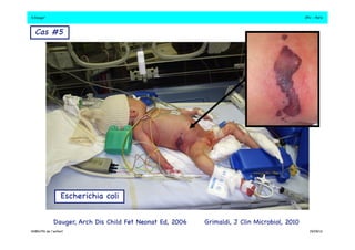 S.Dauger!JPU - Paris! 
Cas #5 ! 
Escherichia coli ! 
Dauger, Arch Dis Child Fet Neonat Ed, 2006! Grimaldi, J Clin Microbiol, 2010! 
DHBN/FN de l’enfant!19/09/13! 
 