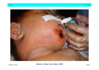 S.Dauger!JPU - Paris! 
DHBN/FN de l’enfant!Gérard, Intens Care Med, 2009!19/09/13! 
 