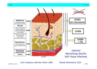 S.Dauger!JPU - Paris! 
Définition! 
Cellulite! 
Cellulitis! 
Necrotizing fasciitis! 
Soft tissue infections! 
Conf consensus, Med Mal Infect, 2000!Blondé, Réanimation, 2013! 
DHBN/FN de l’enfant!19/09/13! 
 