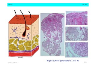 S.Dauger!JPU - Paris! 
DHBN/FN de l’enfant!19/09/13!Biopsie cutanée peropératoire - Cas #1! 
 