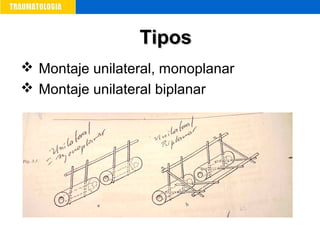  Montaje unilateral, monoplanar
 Montaje unilateral biplanar
TiposTipos
 