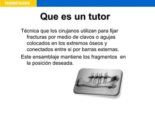 Que es un tutorQue es un tutor
Técnica que los cirujanos utilizan para fijar
fracturas por medio de clavos o agujas
colocados en los extremos óseos y
conectados entre si por barras externas.
Este ensamblaje mantiene los fragmentos en
la posición deseada.
 