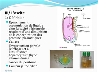 Ponction Ascite
