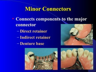Minor Connectors
• Connects components to the major
connector
– Direct retainer
– Indirect retainer
– Denture base

 